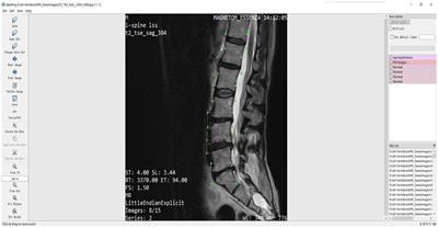 Spinal disease diagnosis assistant based on MRI images using deep transfer learning methods